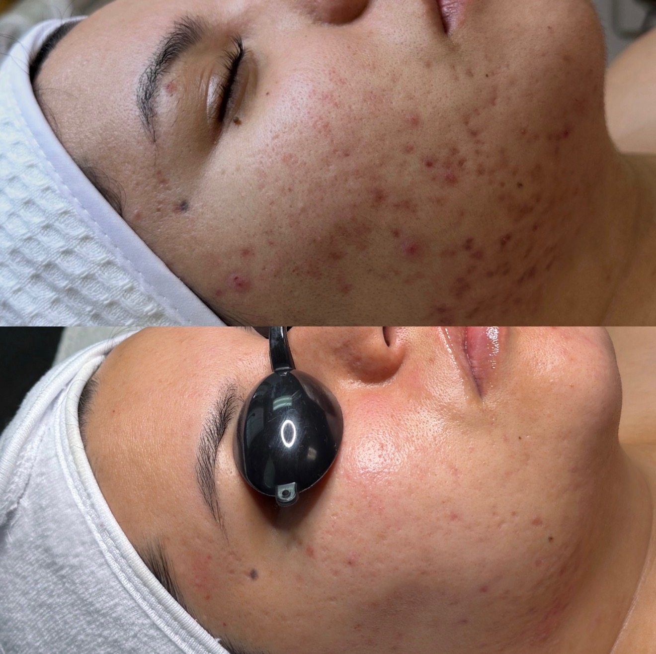 Client skin clearing after acne-focused facials