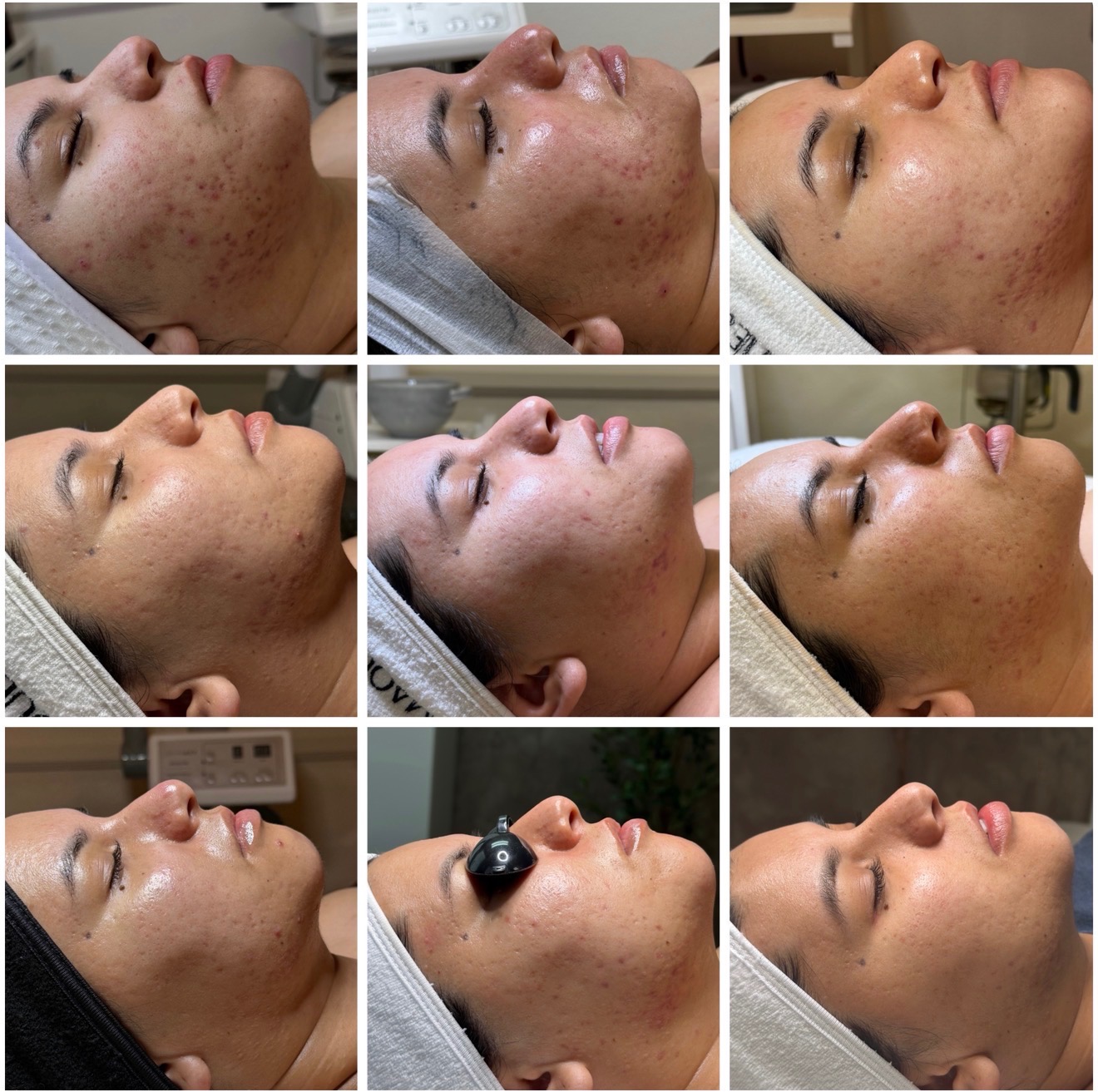 Client acne progress over a course of treatments